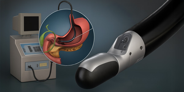 EUS (Endoscopic Ultrasound)