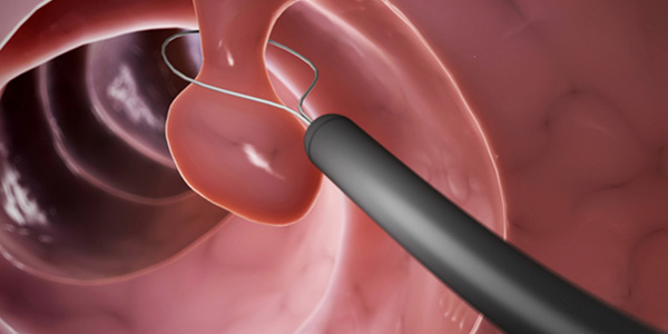 Polypectomy