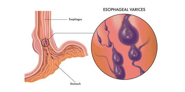 EVL (Endoscopic Variceal Ligation)